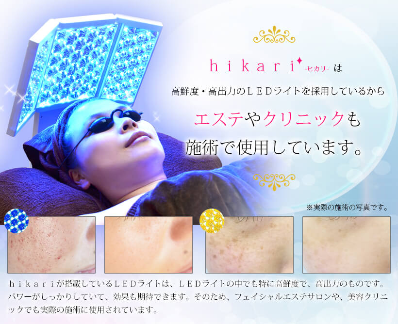 楽天市場】フォトフェイシャル 美顔器 リフトアップ 光美容器【美ルル