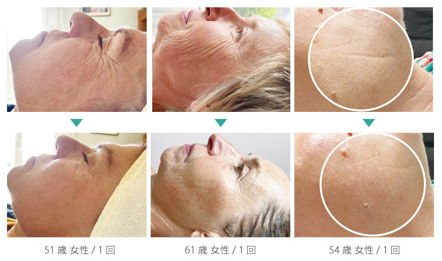 高周波機器WINBACKのフェイシャル専用機「NeoLift（ネオリフト）」の