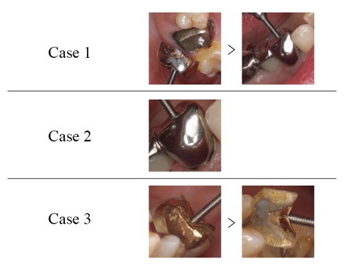 イージークラウンリムーバー｜株式会社フォレスト・ワン 矯正歯科