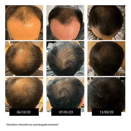 CurrentBody LED Hair Regrowth Device | Hair Loss Cure 2020