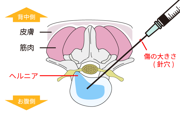 椎間板内酵素注入療法（ヘルニコア注入）｜岩井整形外科病院