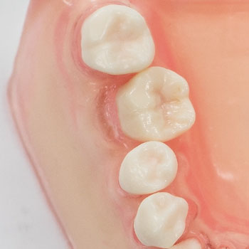 SRP実習用顎模型 [P15FE-MINT.1]｜株式会社ニッシン｜歯科模型・歯科