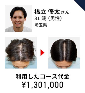 リーブ21の料金大公開！ | 薄毛対策・発毛専門のリーブ21