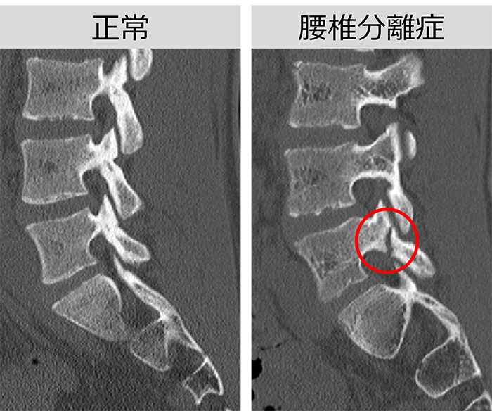 腰椎分離症・分離すべり症｜疾患別治療・リハビリテーション｜丸太町
