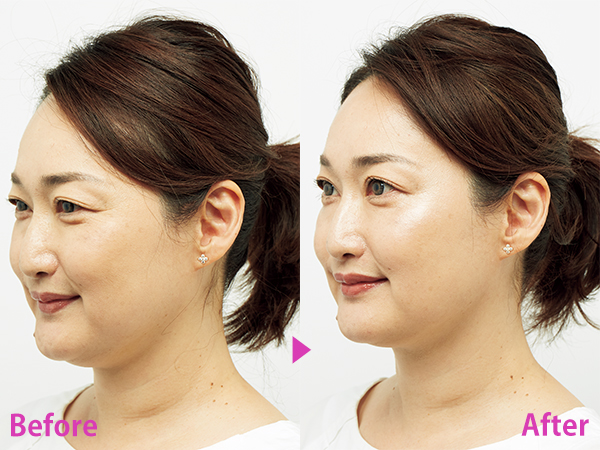 頭皮ケア美顔器】を40代50代がお試し！ビフォーアフター | 美ST ONLINE