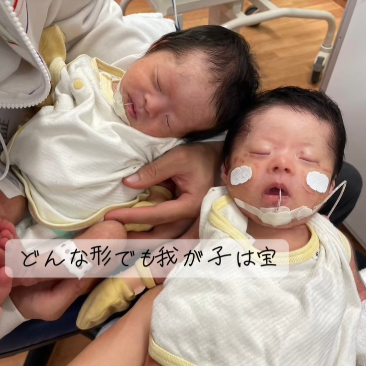 出産後に発覚、双子が2人ともダウン症…前を向く覚悟を決めた夫婦の想い