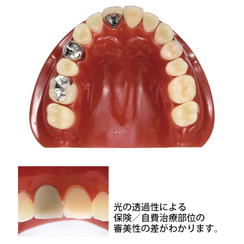 補綴物説明模型 Aの通販 | CiモールLABO | Ciモール