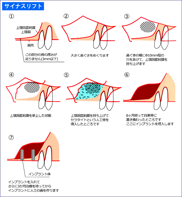 上顎洞挙上術（サイナスリフト・ソケットリフト） - さいたま
