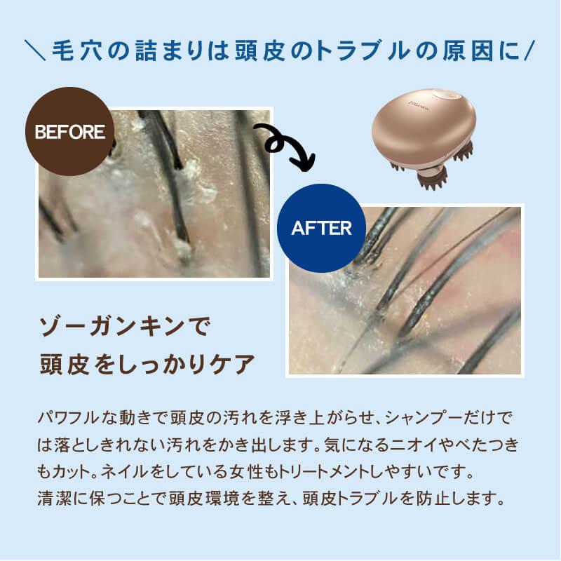 ゾーガンキンスカルプ EMS ヘッドスパ 頭皮 頭皮ケア 送料無料