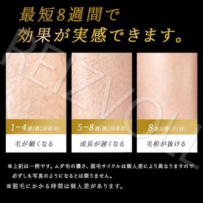 IPL光脱毛器 1年保証 痛くないハイパワー家庭用全身脱毛機で自宅を