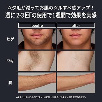 Amazon | 【2024年新モデル】Ulike Men 脱毛器 メンズ 髭 VIO対応 痛み