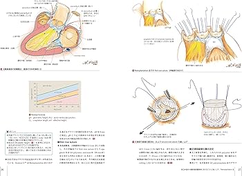 大動脈疾患の手術 (心臓血管外科手術エクセレンス) | 長田信洋, 大北