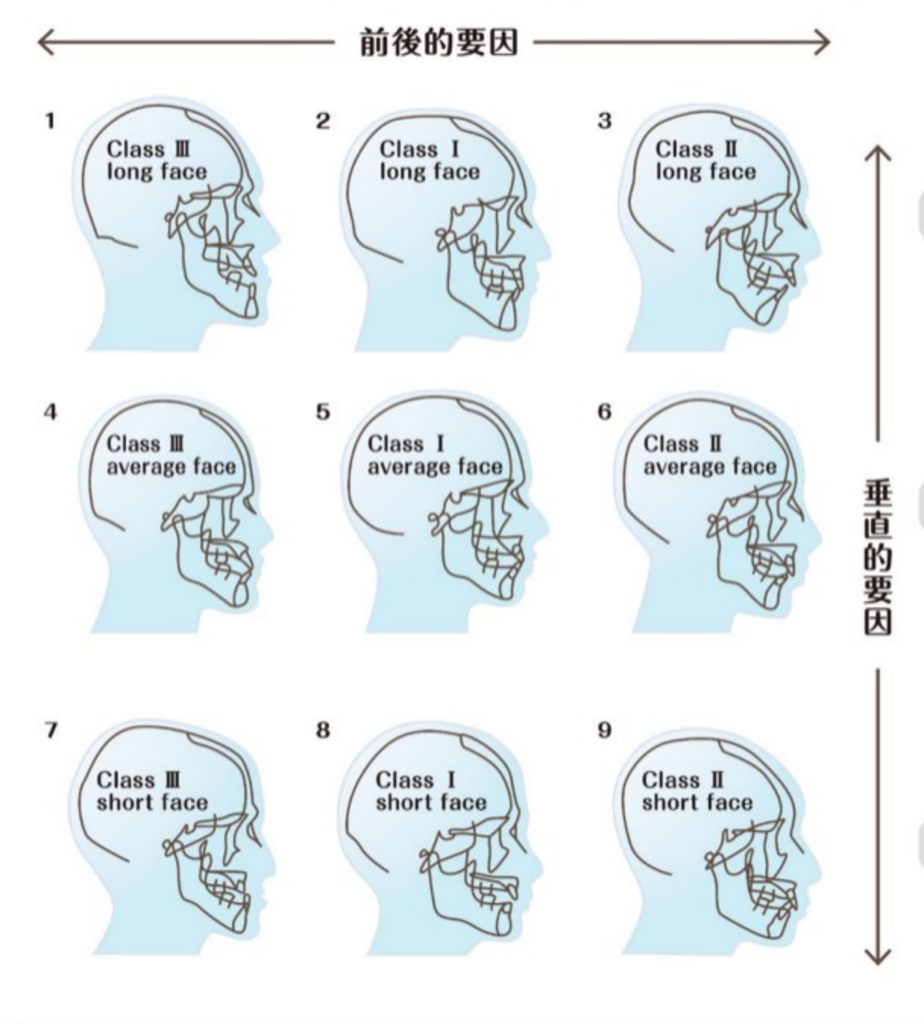 セファロ分析って何？顔の特徴から読み解く矯正治療の方法 part1